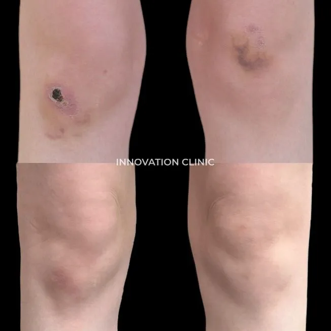 Ускорение схождения гематомы фото до и после 2