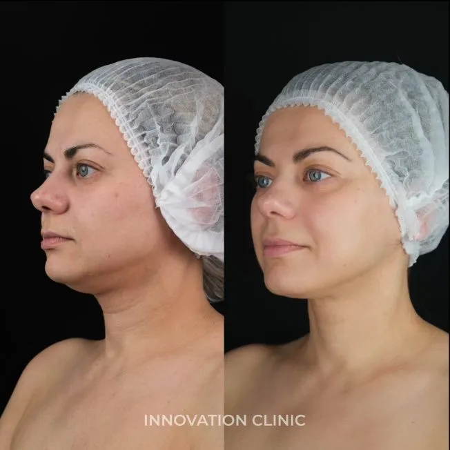 Процедура VOLFORMER фото до и после 2