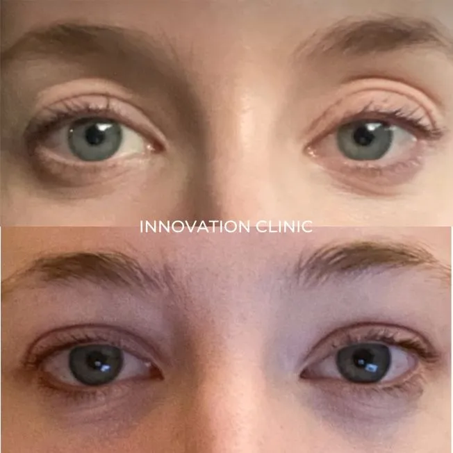 Коррекция формы верхнего века фото до и после 2