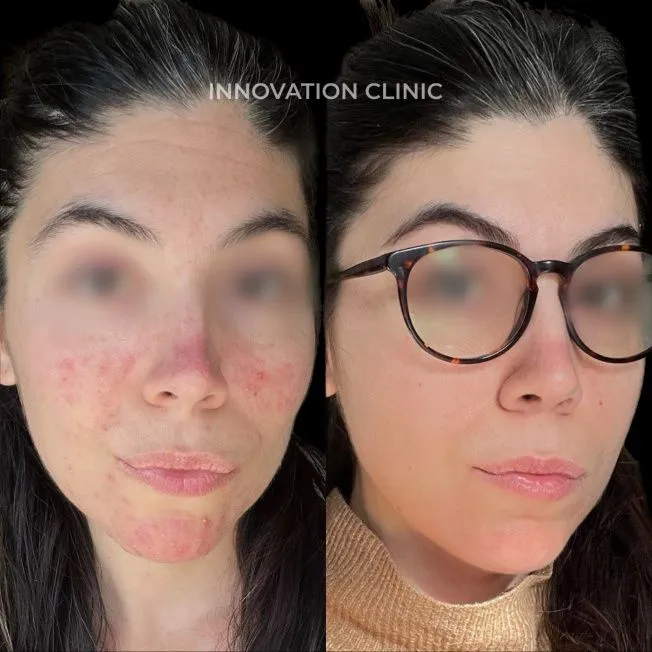 Комплексное лечение акне фото до и после 18