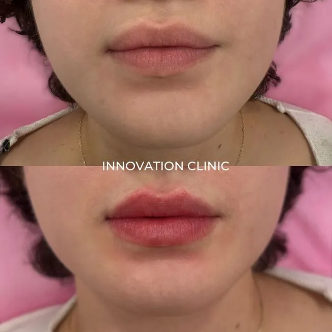 Коррекция формы губ филлером фото до и после 25