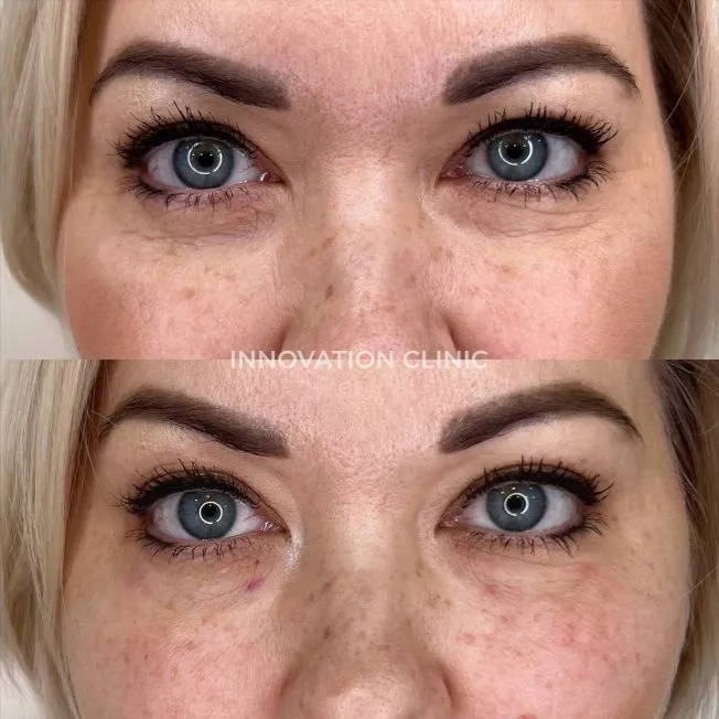 Коррекция носослёзной борозды фото до и после 9