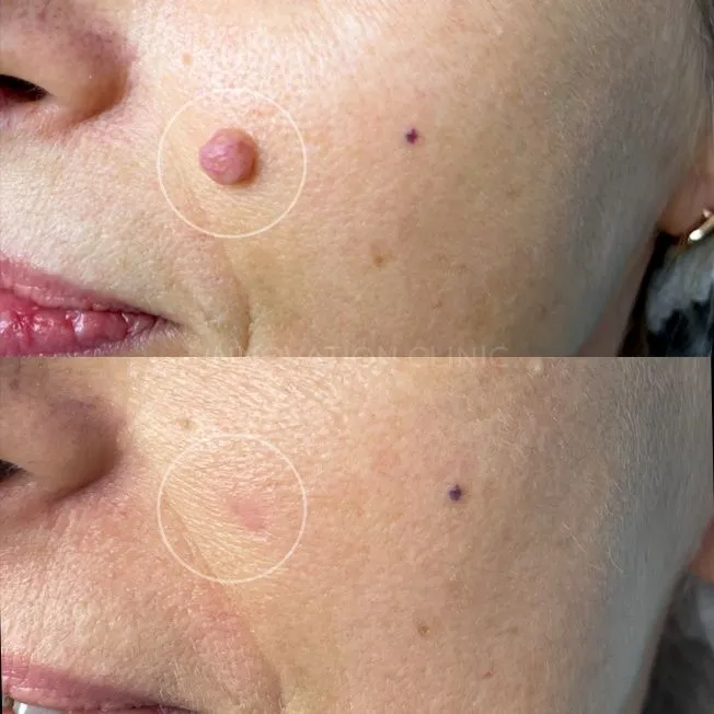 Удаление доброкачественного новообразования фото до и после 1