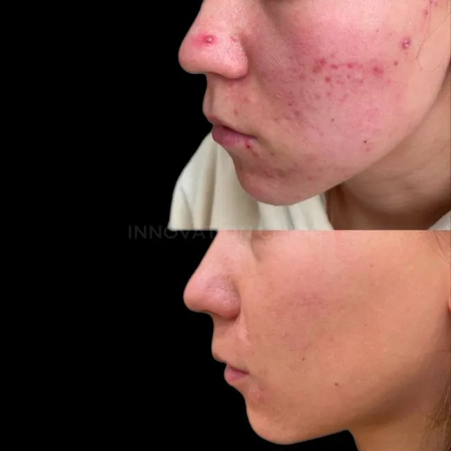Комплексное лечение акне фото до и после 19