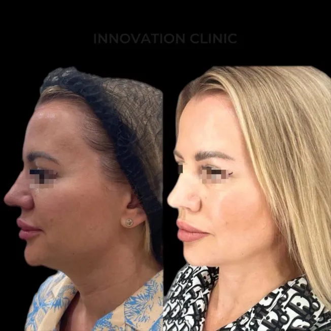 УЗ SMAS-лифтинг нижней трети лица фото до и после 7