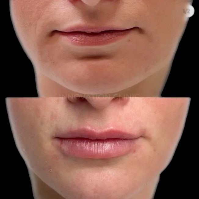 Коррекция формы губ филлером фото до и после 3