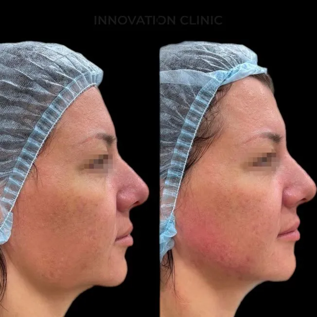 Нитевой лифтинг лица фото до и после 2