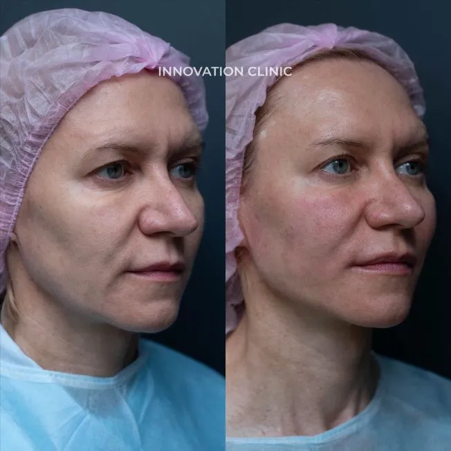 Нитевой лифтинг лица фото до и после 7