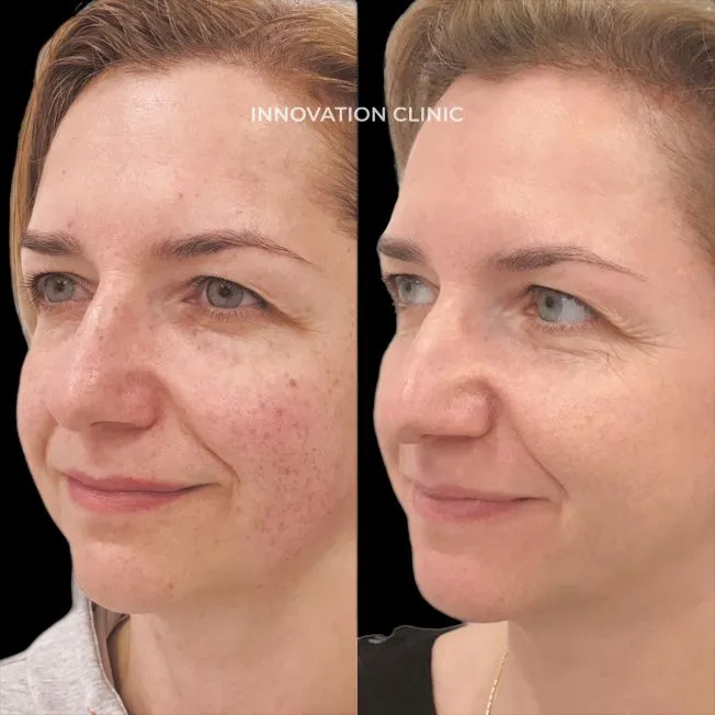 Лечение гиперпигментации кожи фото до и после 2