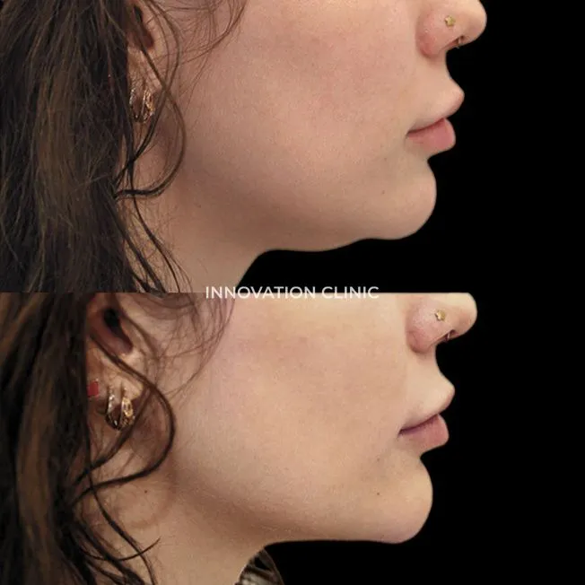 Коррекция подбородка филлером фото до и после 1