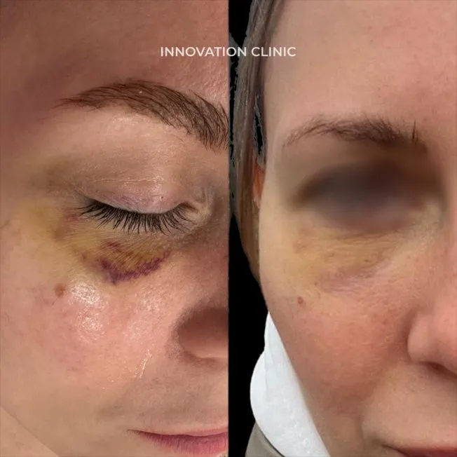 Ускорение схождения гематомы фото до и после 1