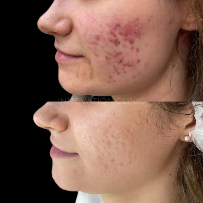 Комплексное лечение акне фото до и после 1