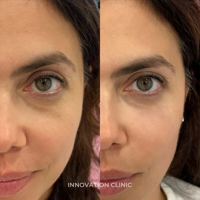 Коррекция носослёзной борозды фото до и после 11