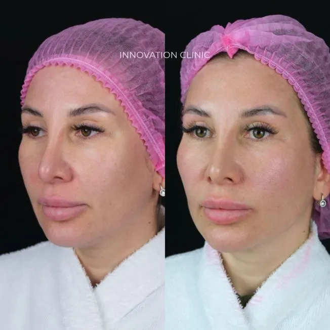 Лифтинг нижней трети лица нитями Aptos  