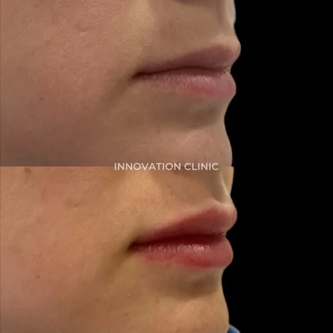 Коррекция формы губ филлером фото до и после 22
