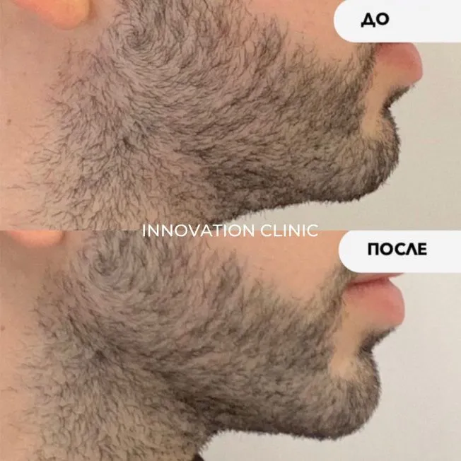 Коррекция углов нижней челюсти фото до и после