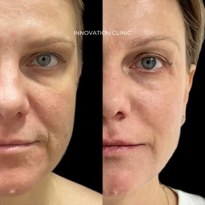 Микроигольчатый RF-лифтинг лица фото до и после 3