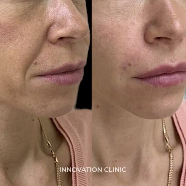 Коррекция носогубных складок фото до и после