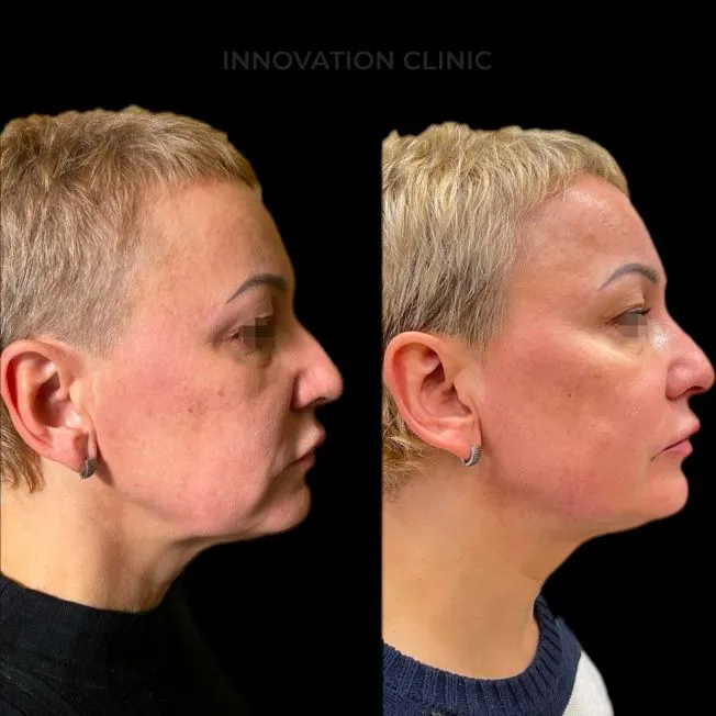 Нитевой лифтинг лица фото до и после 1