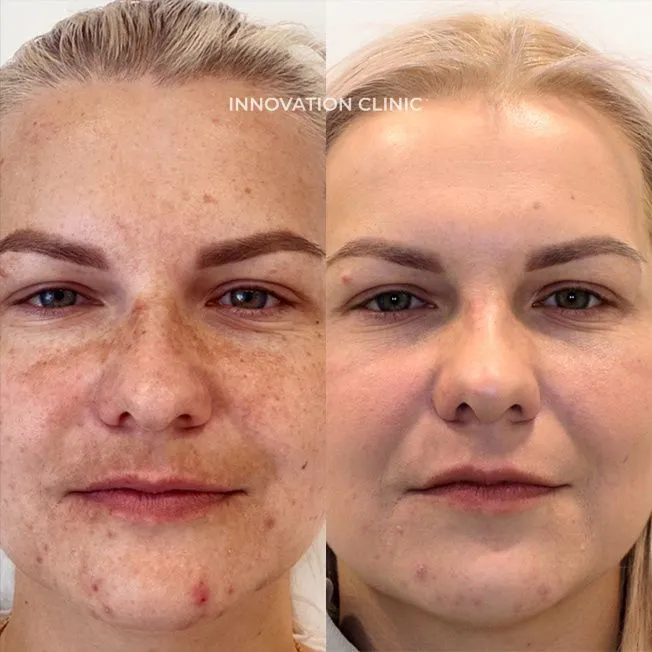 Комбинированное лечение пигментации фото до и после