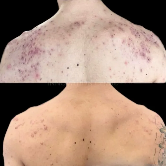 Комплексное лечение акне фото до и после 5