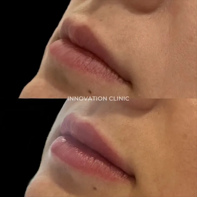 Коррекция формы губ филлером фото до и после 20
