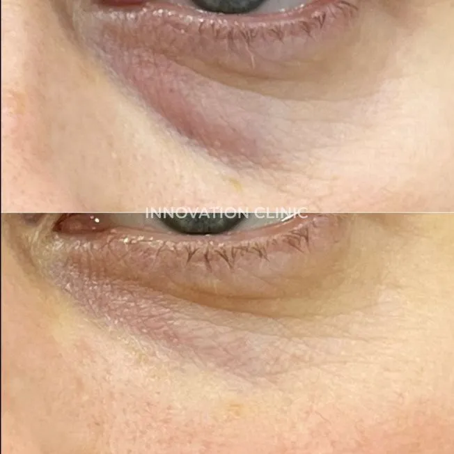 Коррекция носослёзной борозды фото до и после 8