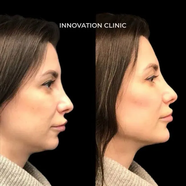FullFace-коррекция лица филлерами фото до и после 2 