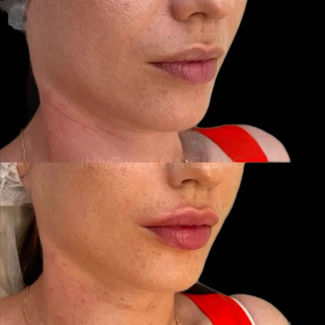Коррекция формы губ филлером фото до и после 1