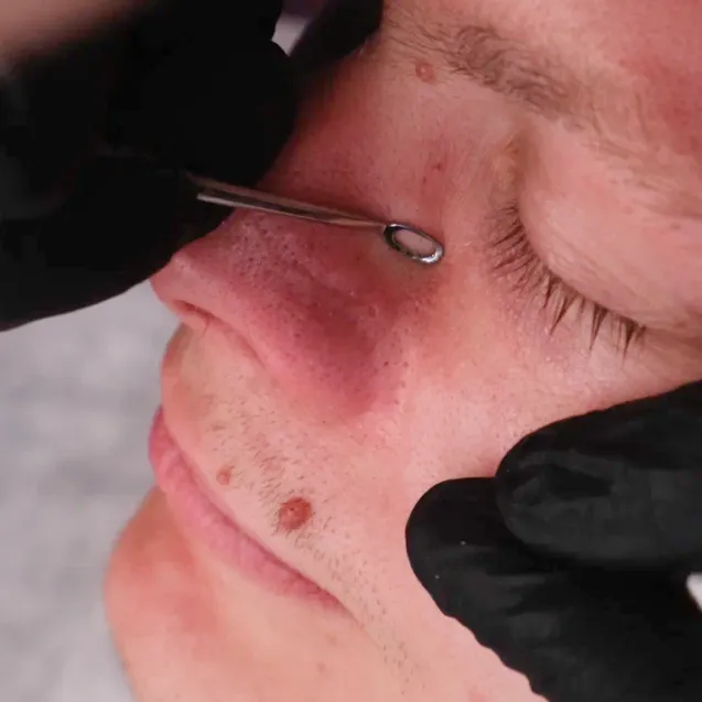 Чистка лица