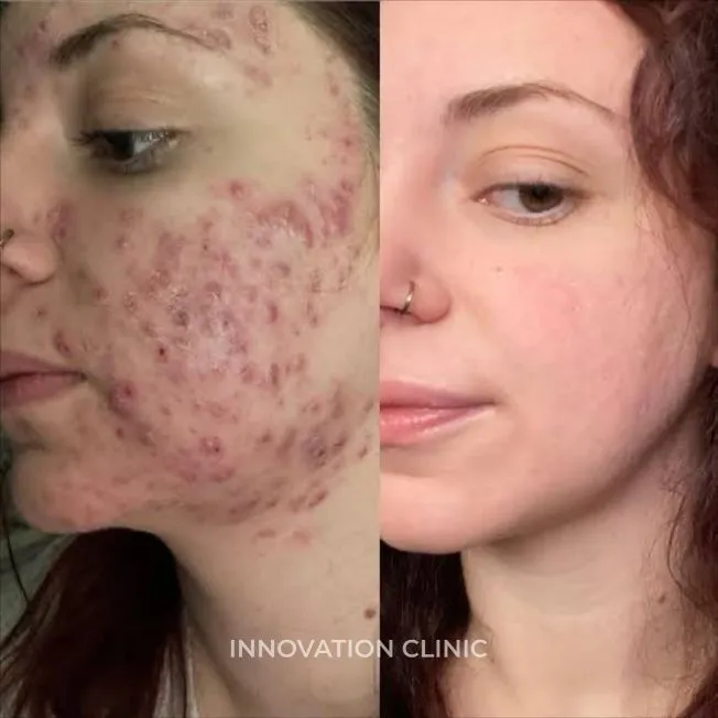 Комплексное лечение акне фото до и после 12