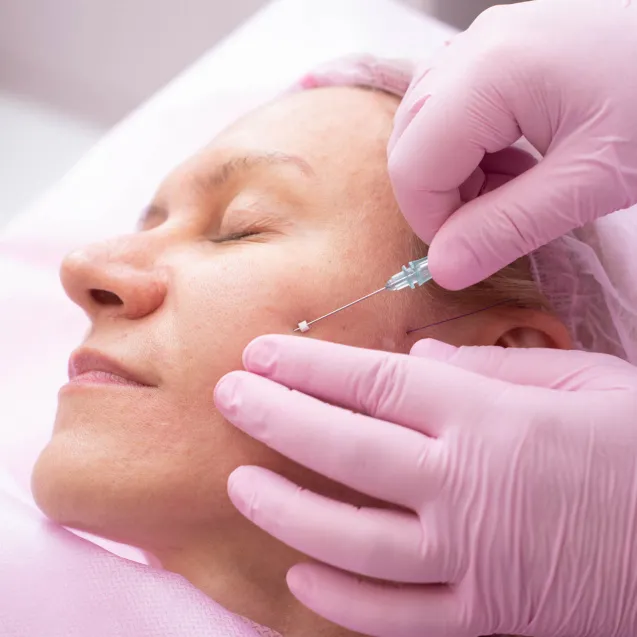 Нитевой лифтинг