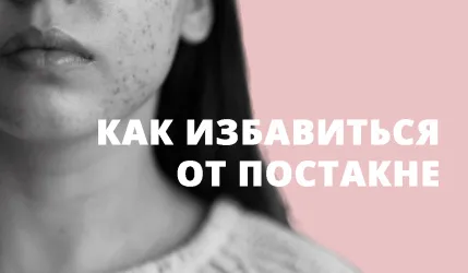 Как избавиться от постакне