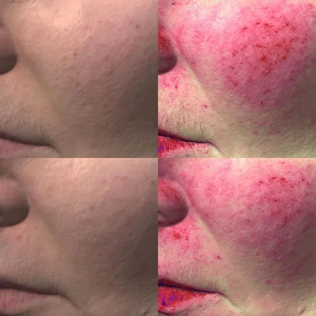 Биореструктуризация препаратом ARES Anti Oxidant фото до и после 1