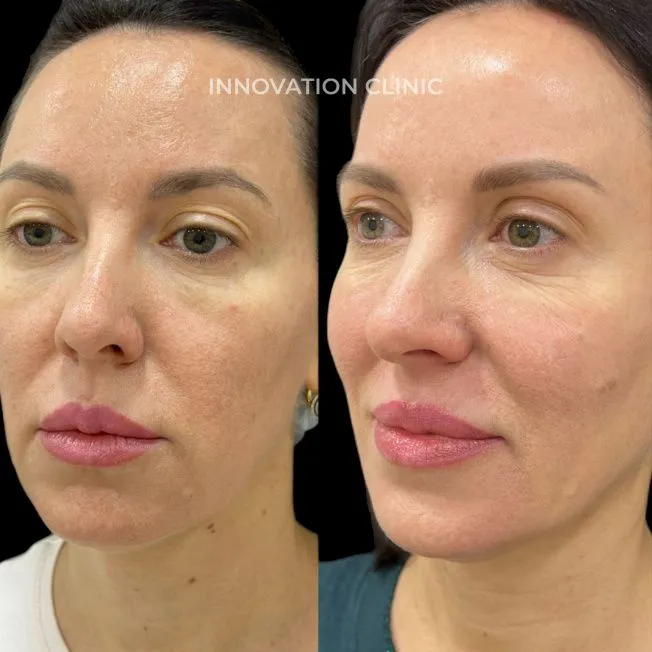 FullFace-коррекция лица филлерами фото до и после 4