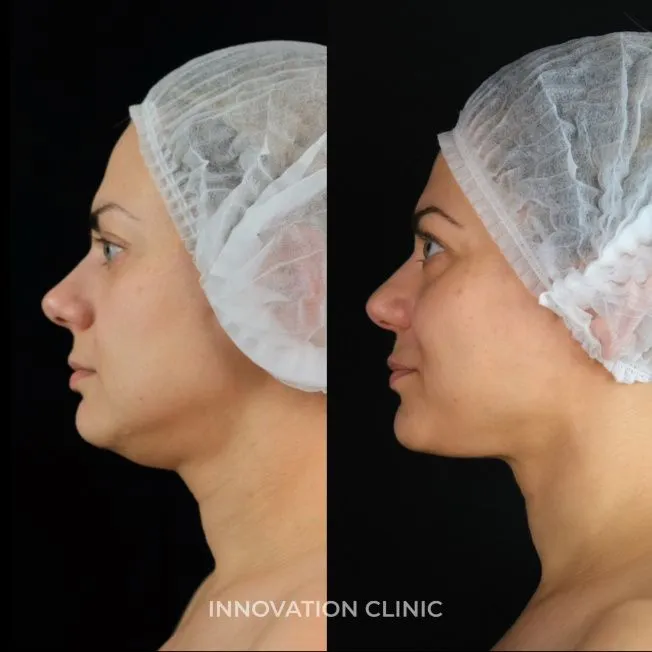 Процедура VOLFORMER фото до и после 1