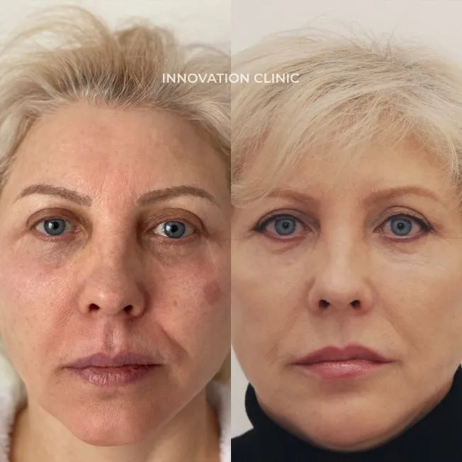 Лазерная шлифовка лица фото до и после 3