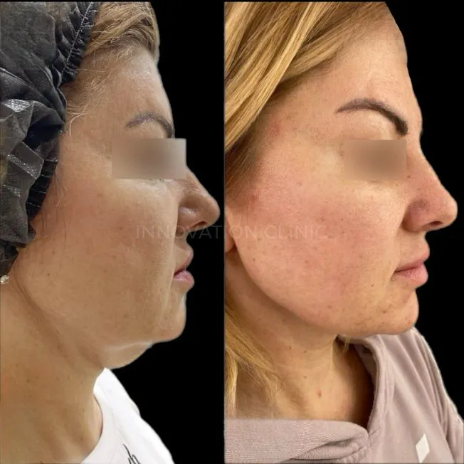 УЗ SMAS-лифтинг нижней трети лица фото до и после 3