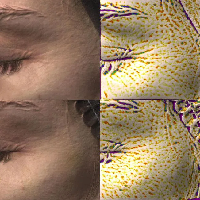 Биореструктуризация препаратом ARES Anti-Age фото до и после 5