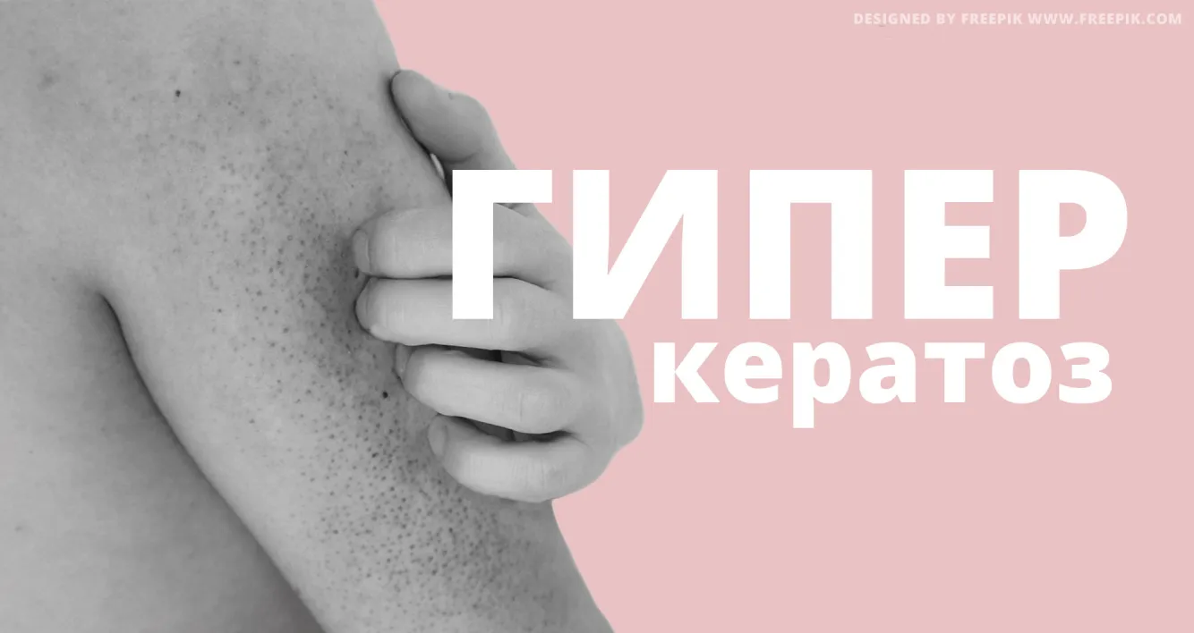 Гиперкератоз