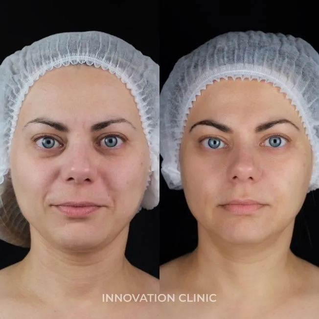 Процедура VOLFORMER фото до и после 3