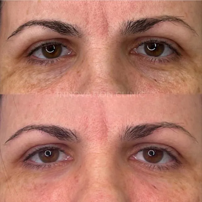 Коррекция носослёзной борозды фото до и после 10