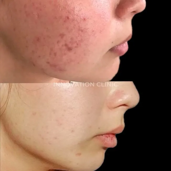 Комплексное лечение акне фото до и после 21