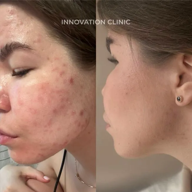 Комплексное лечение акне фото до и после 16