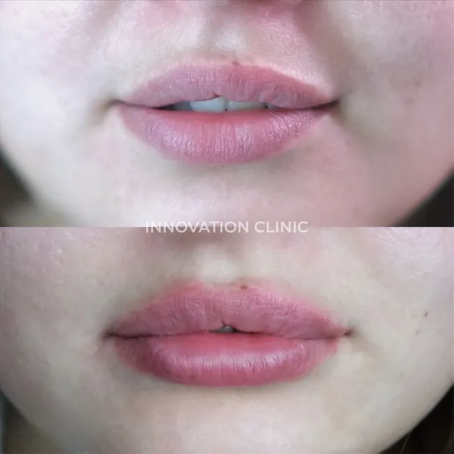 Коррекция формы губ филлером фото до и после 9