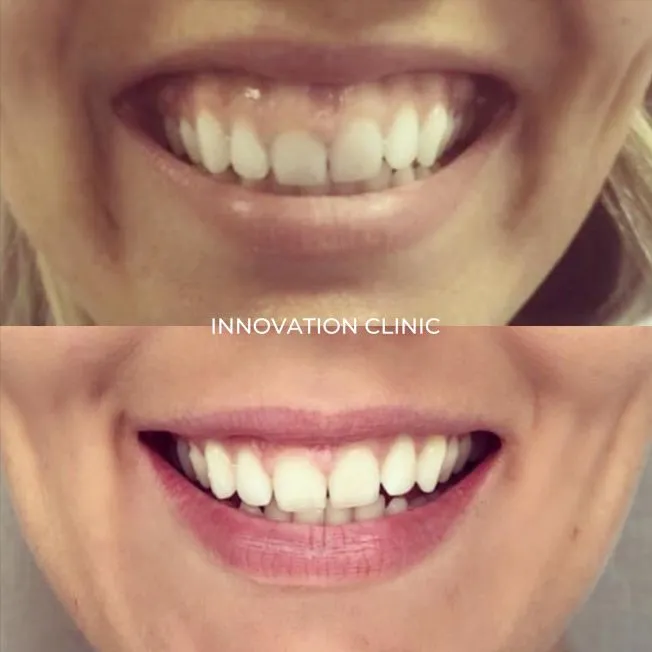 Устранение гингивальной улыбки фото до и после