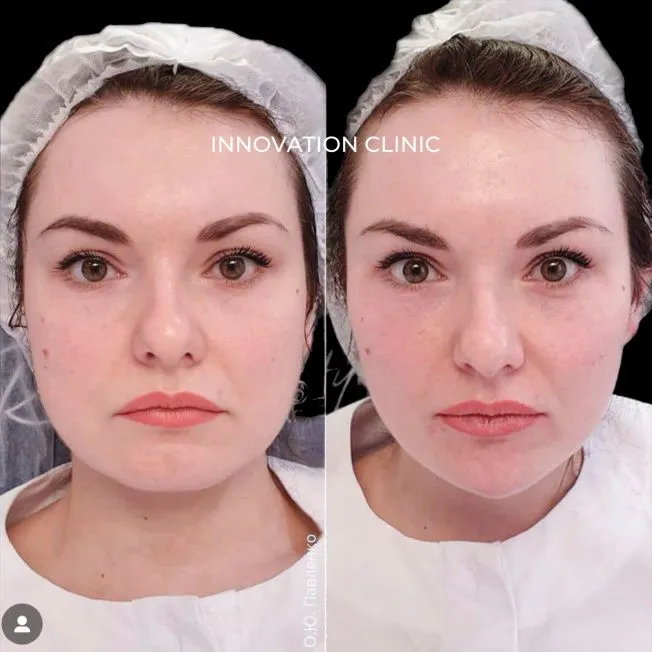 FullFace-коррекция лица филлерами фото до и после 7