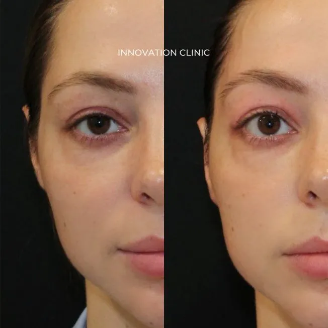 Монополярный RF-лифтинг Volnewmer фото до и после 8