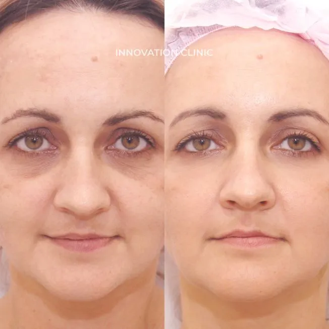 Лечение гиперпигментации кожи фото до и после 1