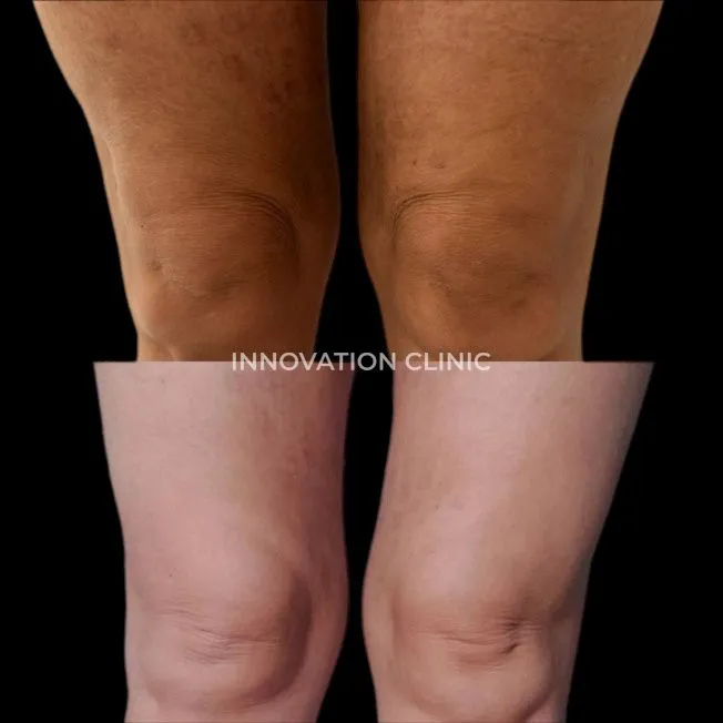 Малоинвазивный RF-лифтинг фото до и после 2